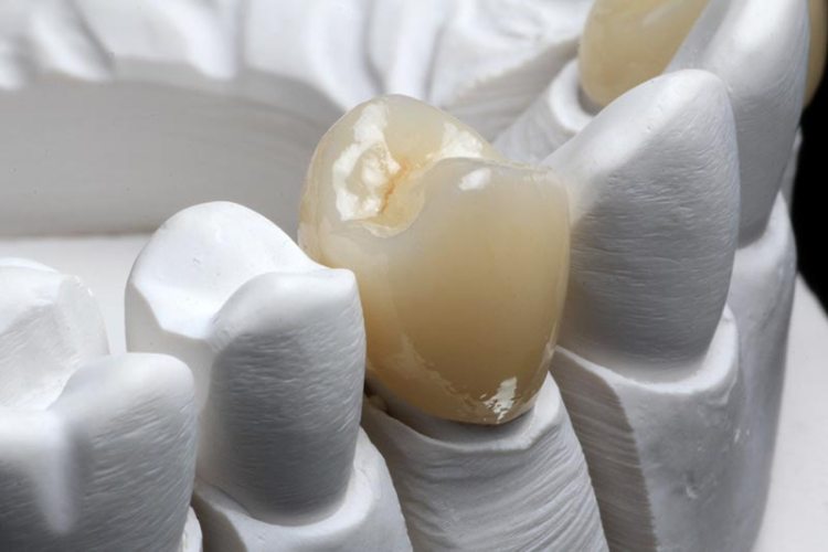Adhezyjne uzupełnienia porcelanowe w systemie CAD/CAM Cerec – opis przypadku