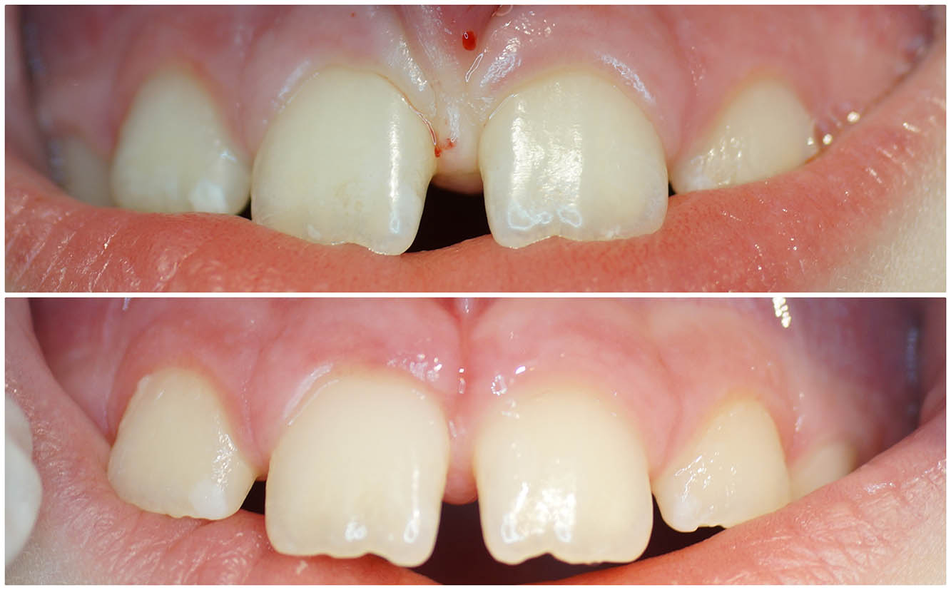 Ryc. 5 Widoczne przesunięcie przyśrodkowe zębów siecznych już po 2 tygodniach od zabiegu frenulektomii.