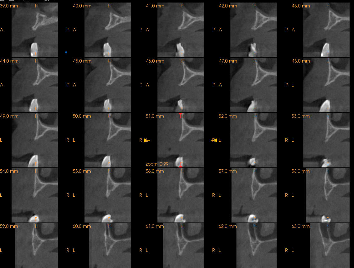 Ryc. 2 Ocena ilościowo-jakościowa wyrostka zębodołowego na podstawie tomografii stożkowej CBCT (CS 9000 3D, Carestream Health Inc, USA).