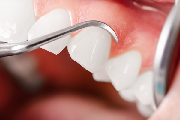 Jak uniknąć błędu w leczeniu periodontologicznym?