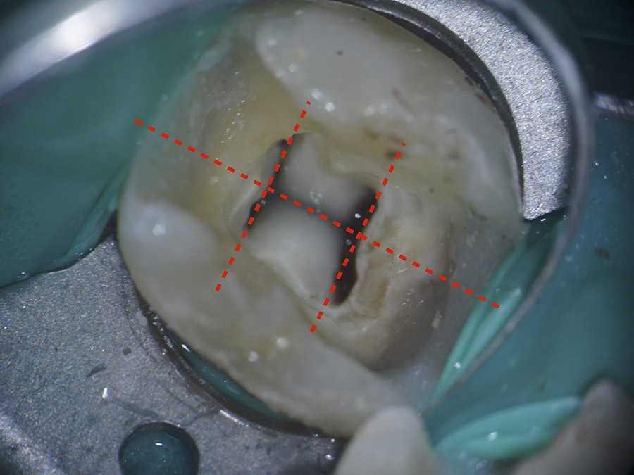 Ryc. 1 - Widok wewnątrz komory pierwszego dolnego zęba trzonowego