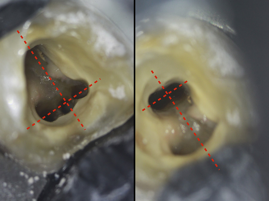Ryc. 2 - Widok wewnątrz komory pierwszego dolnego zęba trzonowego z anatomią pięciokanałową