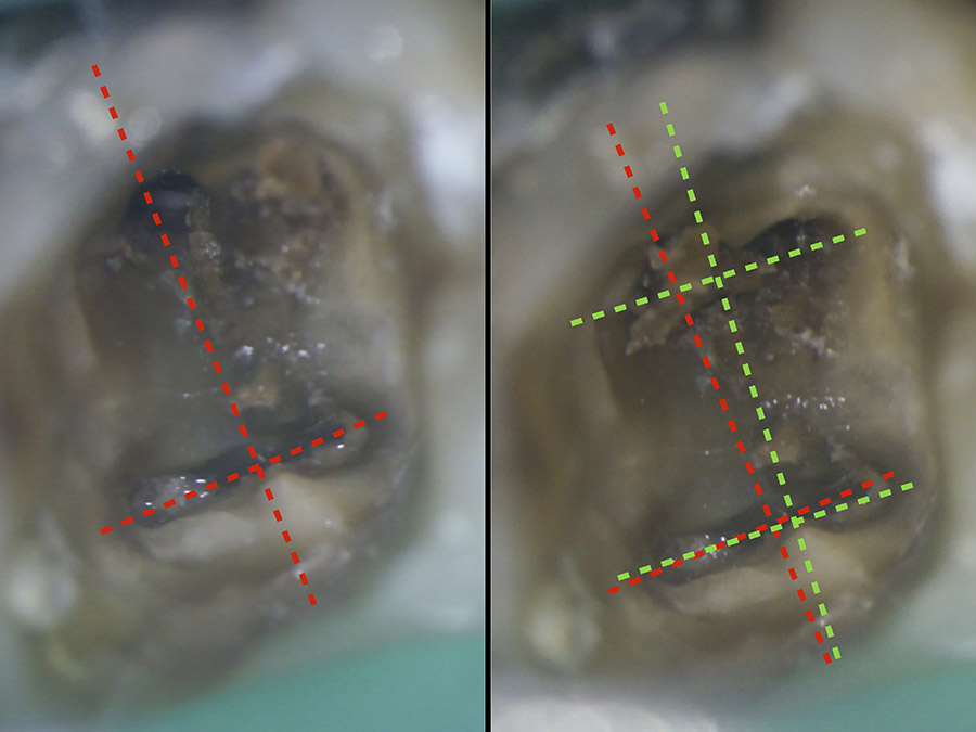 Ryc. 3 - Zobrazowanie różnicy w symetrii podyktowanej uwzględnieniem prawa zmiany koloru w pierwszym dolnym zębie trzonowym