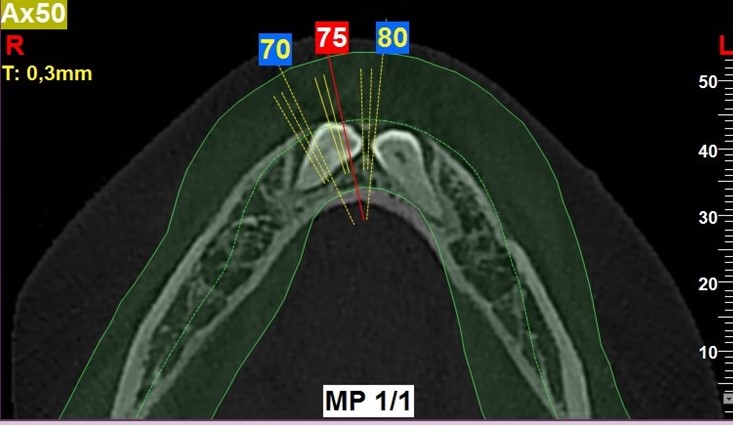Ryc. 6. Rekonstrukcja pantomograficzna oraz skany tomografii wiązki stożkowej wykonanej przed zabiegiem
