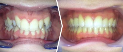Case Study Club: leczenie zębów zatrzymanych