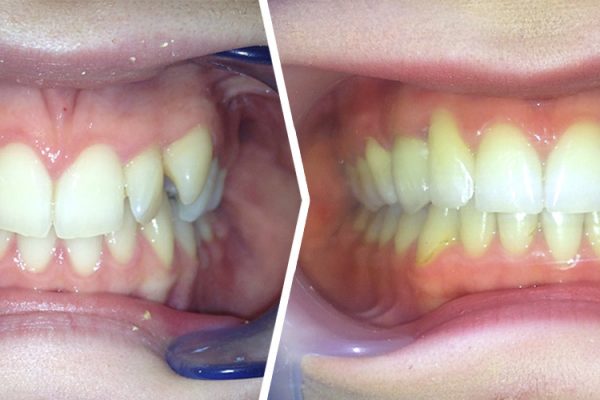 Case Study Club: leczenie zębów zatrzymanych