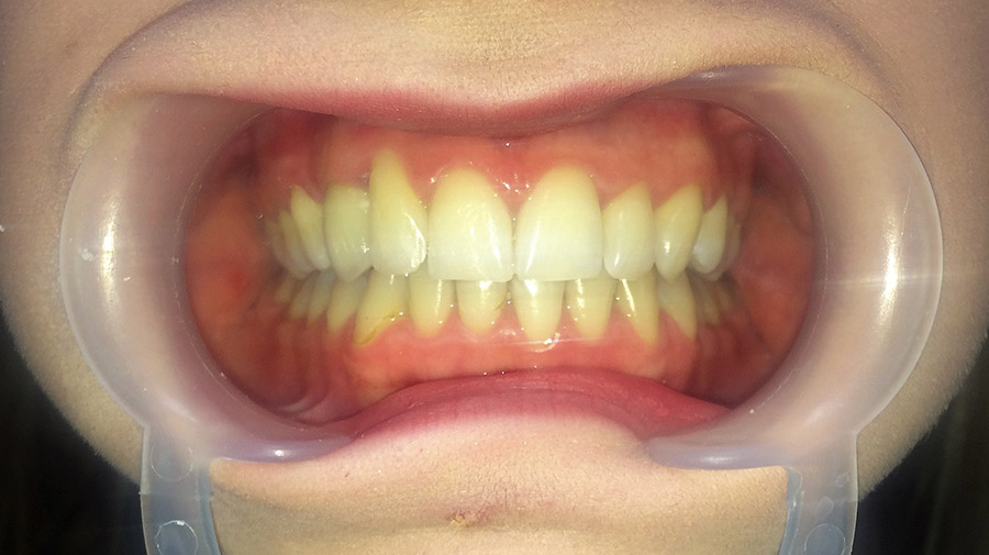 Ryc. 10 Stan po leczeniu ortodontyczno-protetycznym