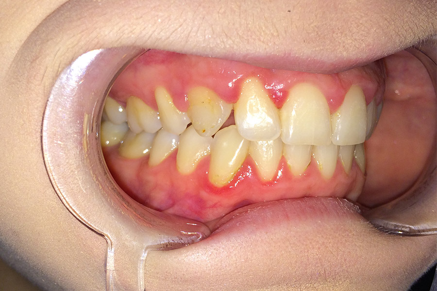 Ryc. 8 Zrotowany ząb 13 po leczeniu ortodontycznym