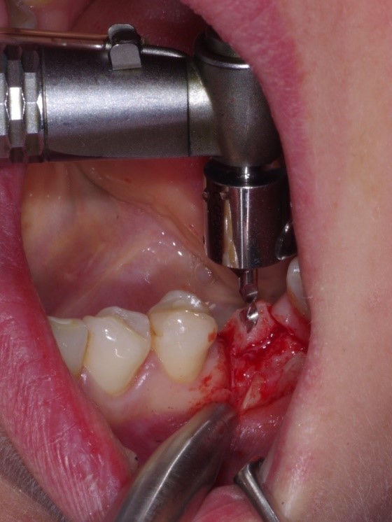 Ryc.2 Pozycjoner firmy WOMKEY MD GUIDE w celu ustalenia pozycji implantu pomiędzy sąsiednimi zębami.