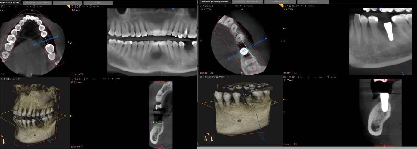 Ryc. 11 Tomografia stożkowa przed i po zabiegu. Usytuowanie implantu w kości.