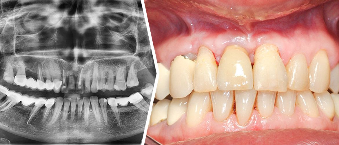 Autogenna zębina w chirurgii regeneracyjnej wyrostka zębodołowego – aspekt implantologiczny