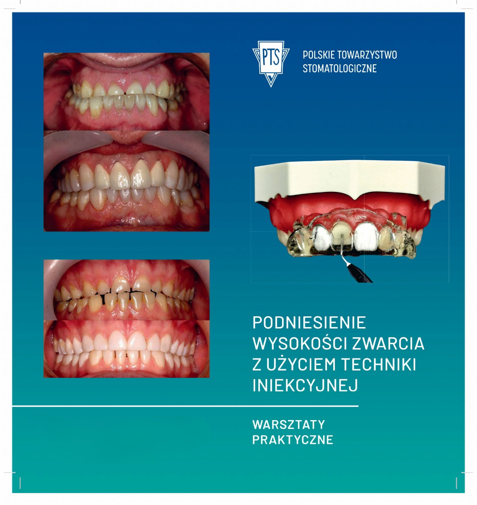 🌟 Zaproszenie na Warsztat: Podniesienie Wysokości Zwarcia u Pacjentów z Patologicznym Starciem Zębów 🌟