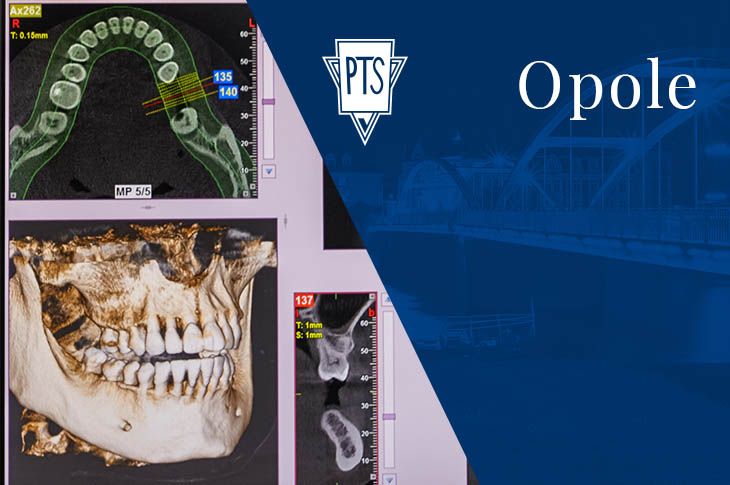 Topografia głów wyrostków kłykciowych żuchwy w diagnostyce tomografii wolumetrycznej u pacjentów z dysfunkcjami stawów skroniowo-żuchwowych