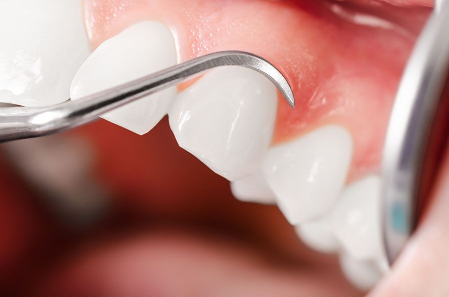 Jak uniknąć błędu w leczeniu periodontologicznym?